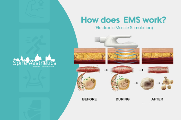 EMS treatment for post pregnancy weight loss treatment Poole