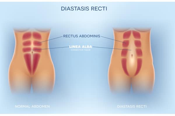 What Non-Surgical Options Are Available for Diastasis Recti Poole?