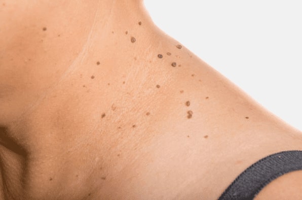 Are you looking for easy skin tag removal Poole - then contact Spire today!